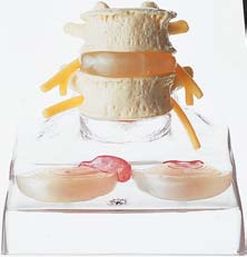 腰椎模型椎間板3種付