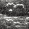 大腿穿刺交換パッド